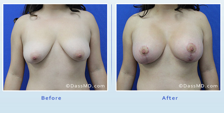 Breast Augmentation with Lift case 4 before after image 1