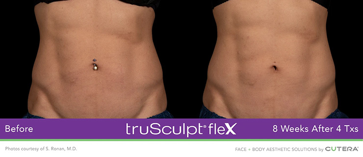 Dr Dennis Dass, TruSculpt Flex Before and After Image 2